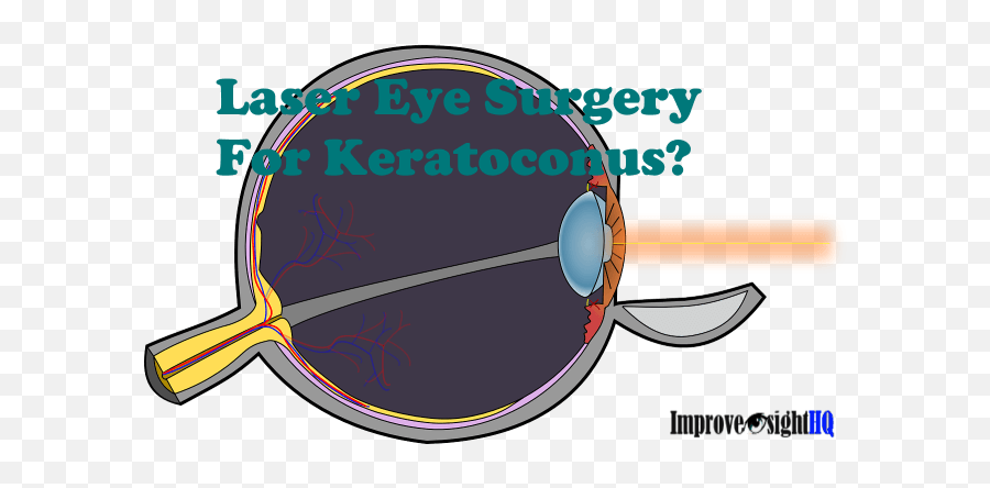Laser Eye Surgery For Keratoconus - Keratoconus Treatment Laser For Keratoconus Treatment Emoji,Laser Eye Png