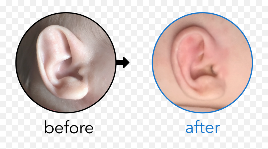 Before U0026 Afters Earbuddies Permanent Solution To Stick Emoji,Elf Ears Png