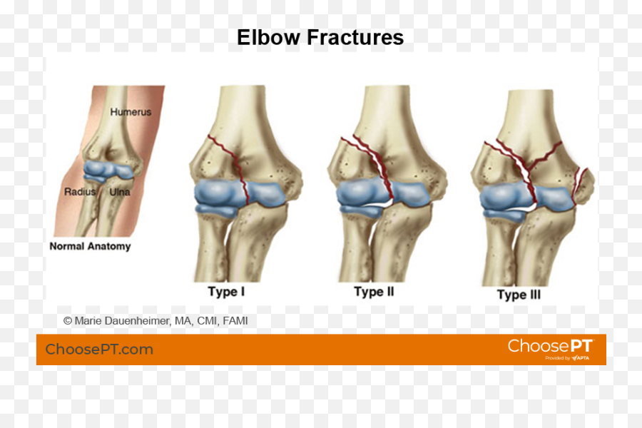 Guide Physical Therapy Guide To Elbow Fracture Choose Pt Emoji,Feels Bad Man Png