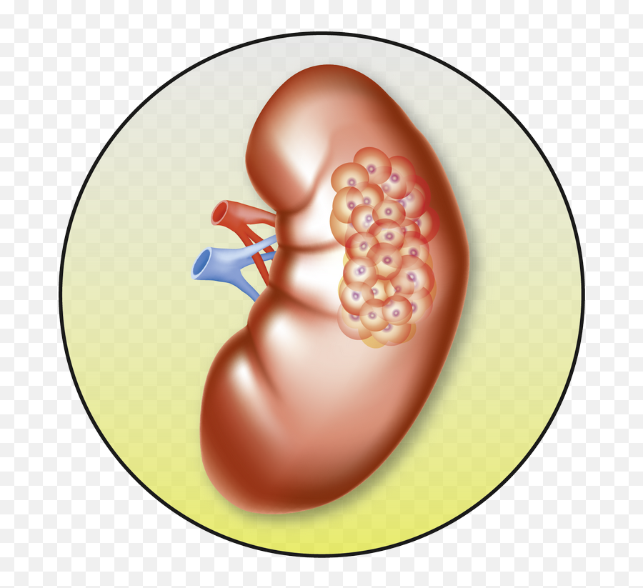 What Is Kidney Cancer - Kidney Cancer Clipart Emoji,Kidney Clipart