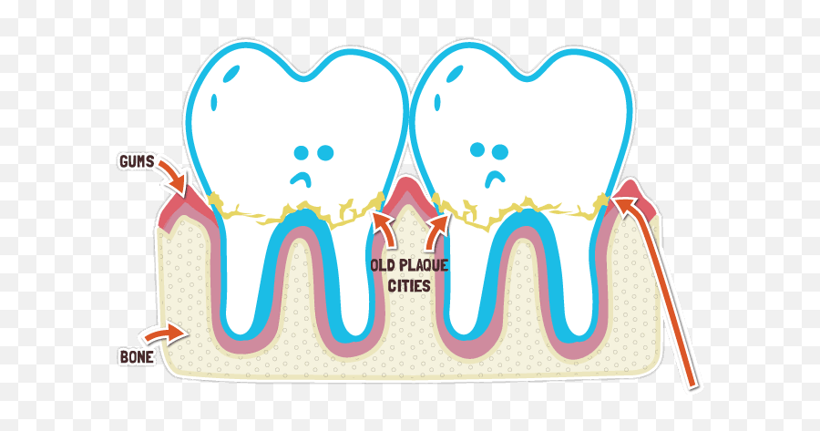 D3 Group - Developmental Dental Defects Plaque Bugs Emoji,Kids Brushing Teeth Clipart