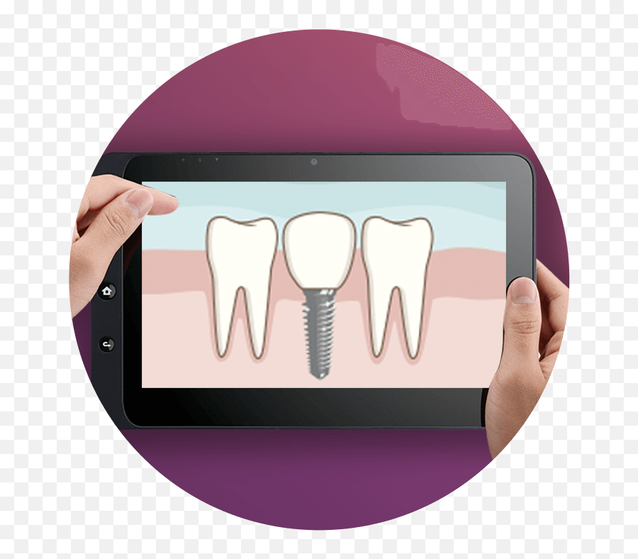 The Dionavi Difference Dionavi Ecodigital Dental Implants - Disease Emoji,Dio Face Png