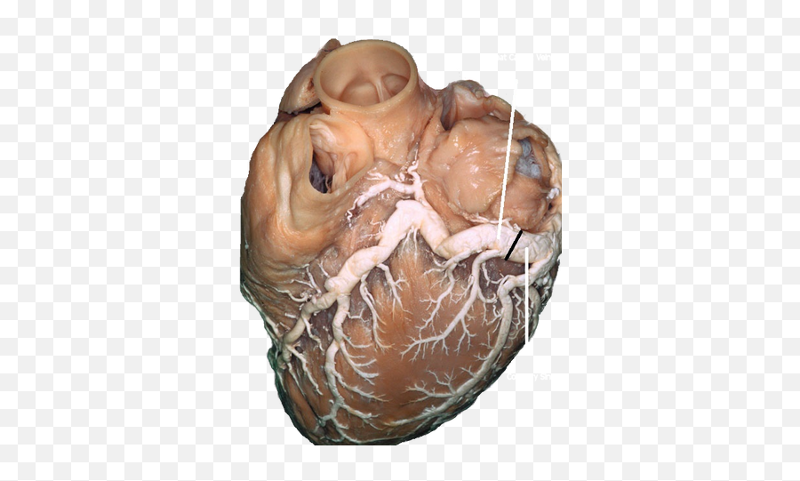 Cardiac Veins - Cthsurgerycom Arteries And Veins Real Emoji,Real Heart Png