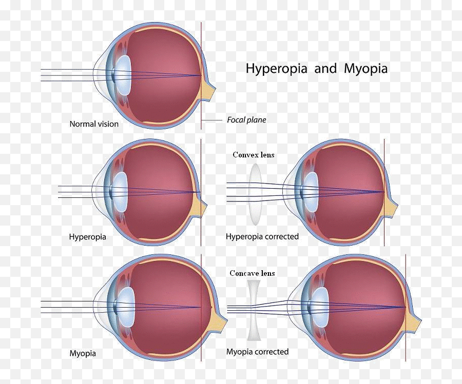 Laser Eye Surgery - Myopia Corrected Emoji,Laser Eyes Transparent