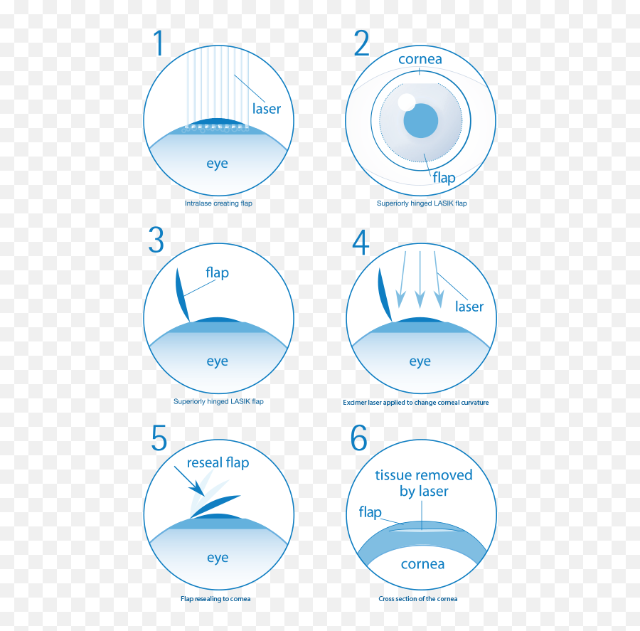 Are You Suitable For Laser Eye Surgery - Lasik Steps Emoji,Laser Eye Png