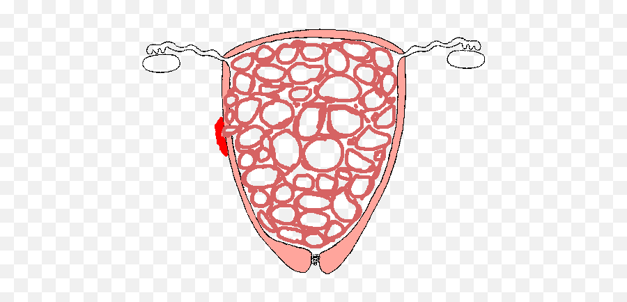 Female Genital Pathology - Gestational Trophoblastic Neoplasia Clipart Emoji,Mole Clipart