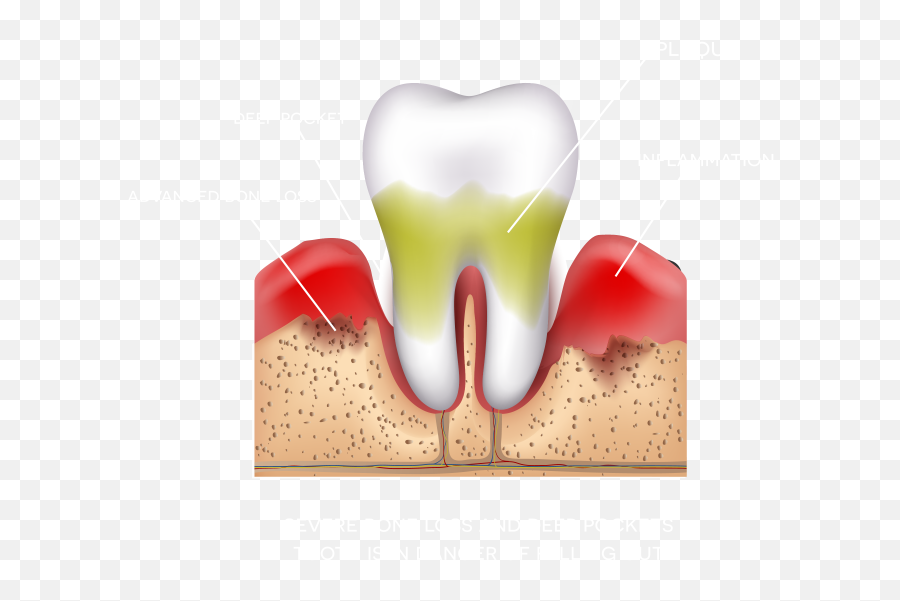 Soft Tissue Grafts - Les Dental Group Happens When You Brush Your Teeth Too Hard Emoji,Roots Clipart