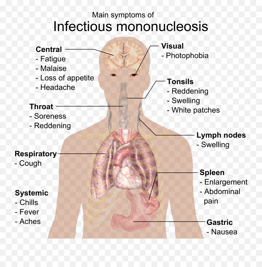 Filemain Symptoms Of Infectious Mononucleosispng - Infectious Mononucleosis Emoji,.png Meaning