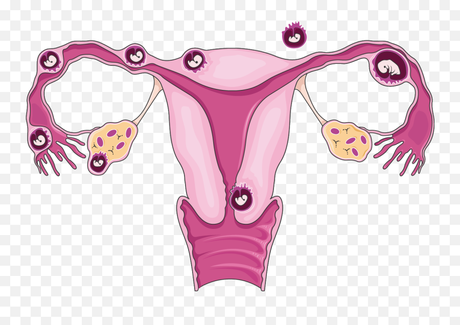 Ectopic Pregnancy - Ectopic Pregnancy Png Emoji,Pregnancy Clipart