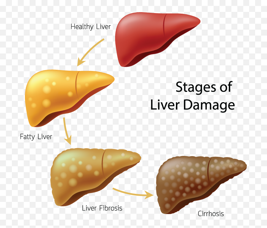 Alcoholic Liver Disease Transparent - Fatty Liver Emoji,Liver Clipart