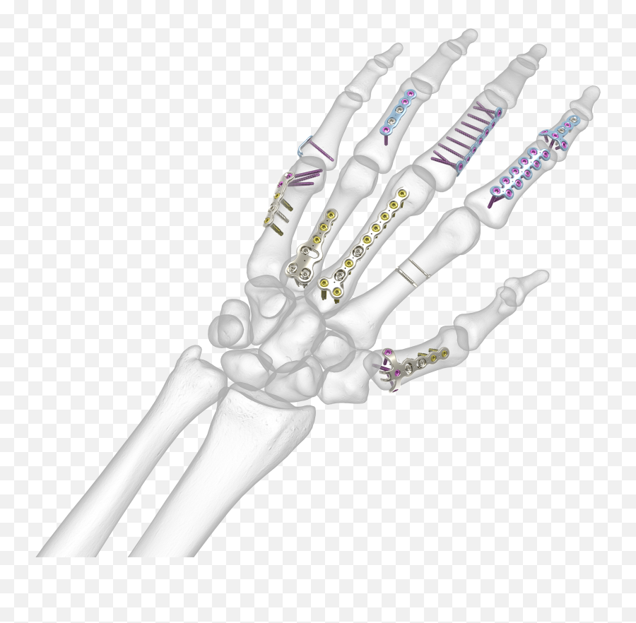 Hand Fracture System On - Bone Acumed Transparent Bone Hand Emoji,Bone Png