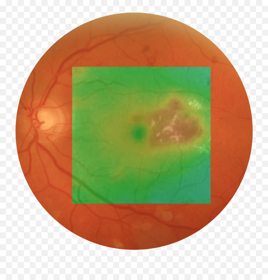 Subliminal Laser Therapy For Retinal Disorders - Subliminal Emoji,Laser Transparent