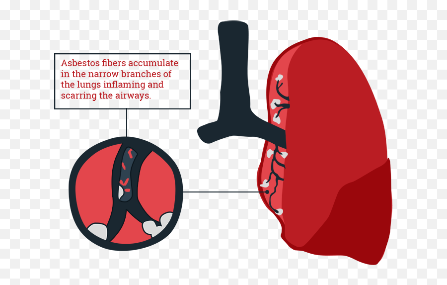 Lungs Clipart Asbestos Lungs Asbestos - Asbestosis Clipart Emoji,Lungs Clipart