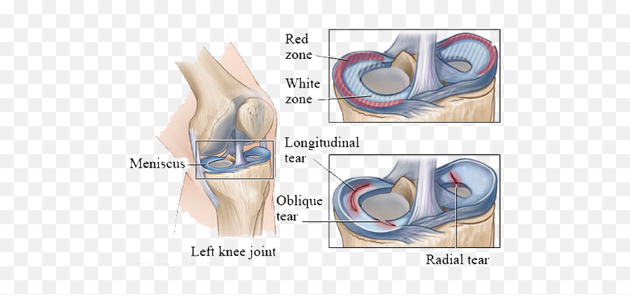 Knee Ligament And Cartilage - The Joint Institute Emoji,Torn Png