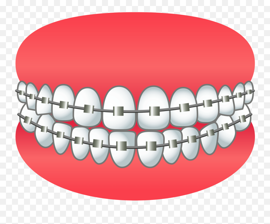 Dental Braces Clipart Free Download Transparent Png - Braces Clipart Png Emoji,Bracket Png