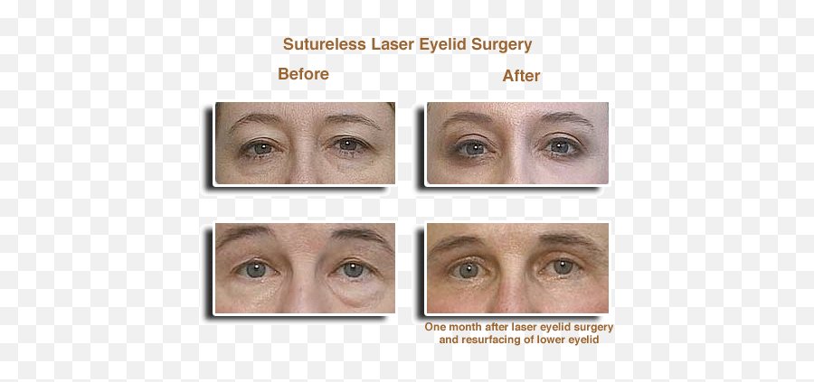 Laser Eyelid Surgery Before U0026 Afters - Eye Laser Surgery For Adult Emoji,Laser Eyes Png