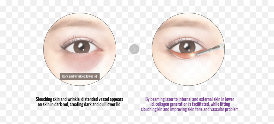 Medlite C6 Nd Yag Laser For Dark Eye Circle - Instantrunasia Nd Yag Laser For Under Eyes Emoji,Laser Eyes Png
