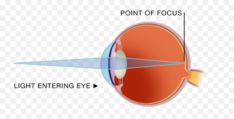 Eye Conditions - Refractive Errors Vistaeyes Laser Eye Clinic Vertical Emoji,Laser Eyes Png