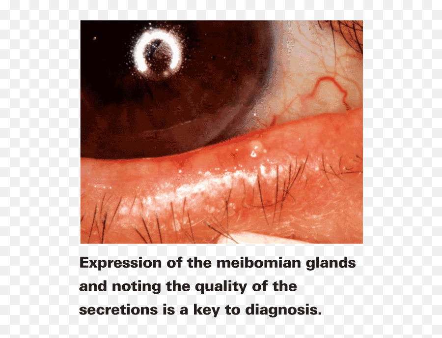 The Experts Open Up On Meibomian Dysfunction - Body Fluid Emoji,Red Eyes Meme Transparent