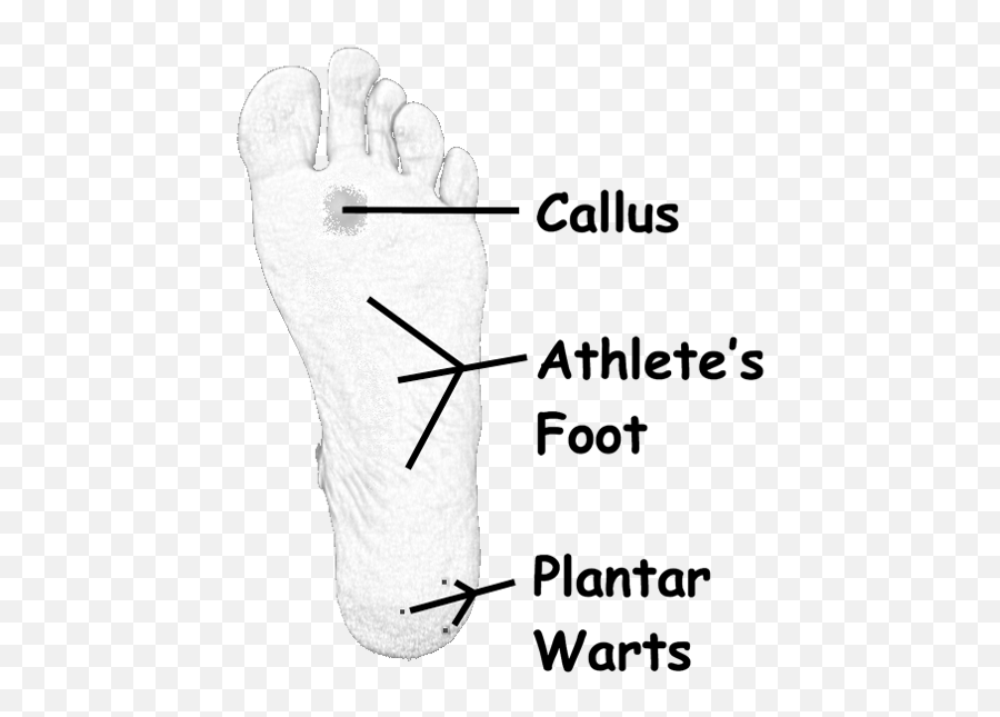Plantar Warts Callouses And Athletes Foot Causing Foot Pain Emoji,Feet Transparent