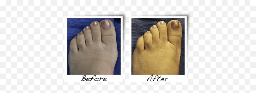 Before After Pictures U2013 Feetfixer Emoji,Feet Transparent
