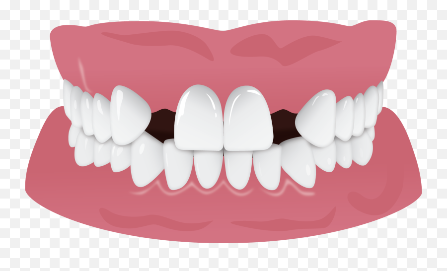 Missing Teeth U2013 Clearcorrect Support Emoji,Gap Clipart