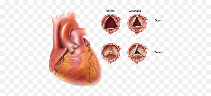 Patient Information Edwards Lifesciences Switzerland Emoji,Human Heart Transparent Background