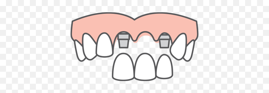 Explore Our Dental Implant Solutions In Spring Hill Tn Emoji,Gap Clipart